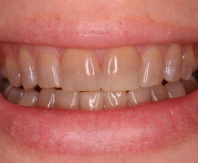 blanqueamiento-dental-antes