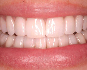 blanqueamiento-dental-despues