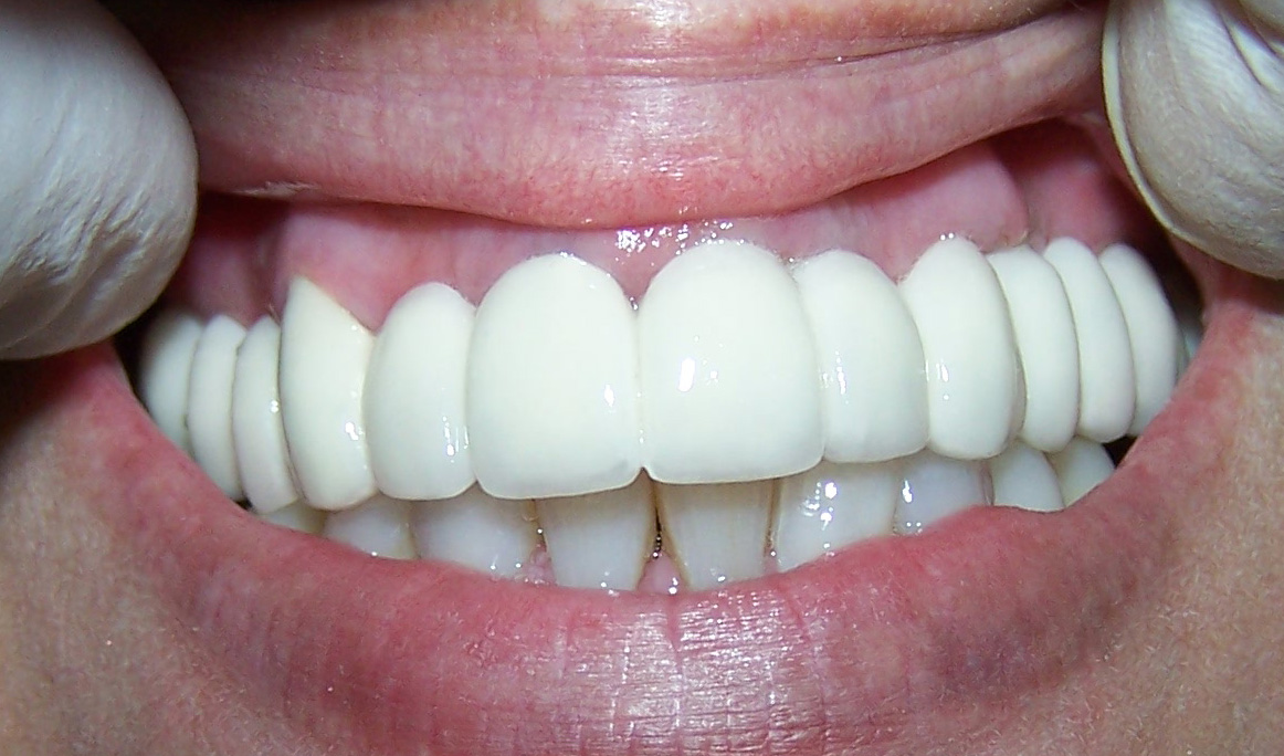 Prótesis Fijas (Coronas Dentales) Clinica Dental Sonrisalud