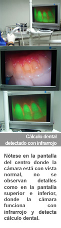 calculo-dental