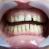 dientes-infectados-antes