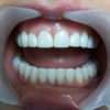 dientes-infectados-despues