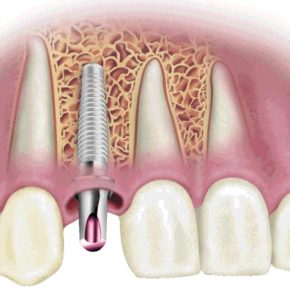 implantes-dentales