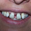 paciente-restauracion-dental-antes