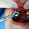 implantes-dentales-cirugia