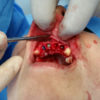 proceso-dentales-implantes